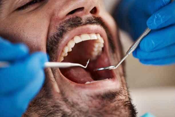 Best Emergency Wisdom Teeth Removal in Massanutten, VA